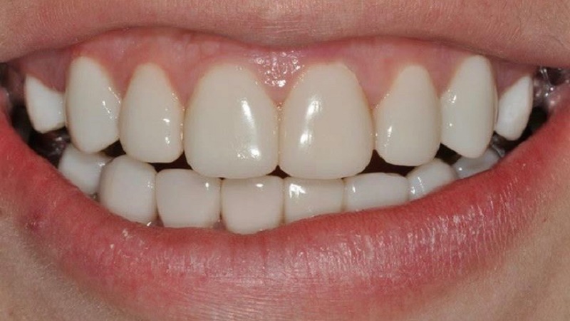 Fluorosis